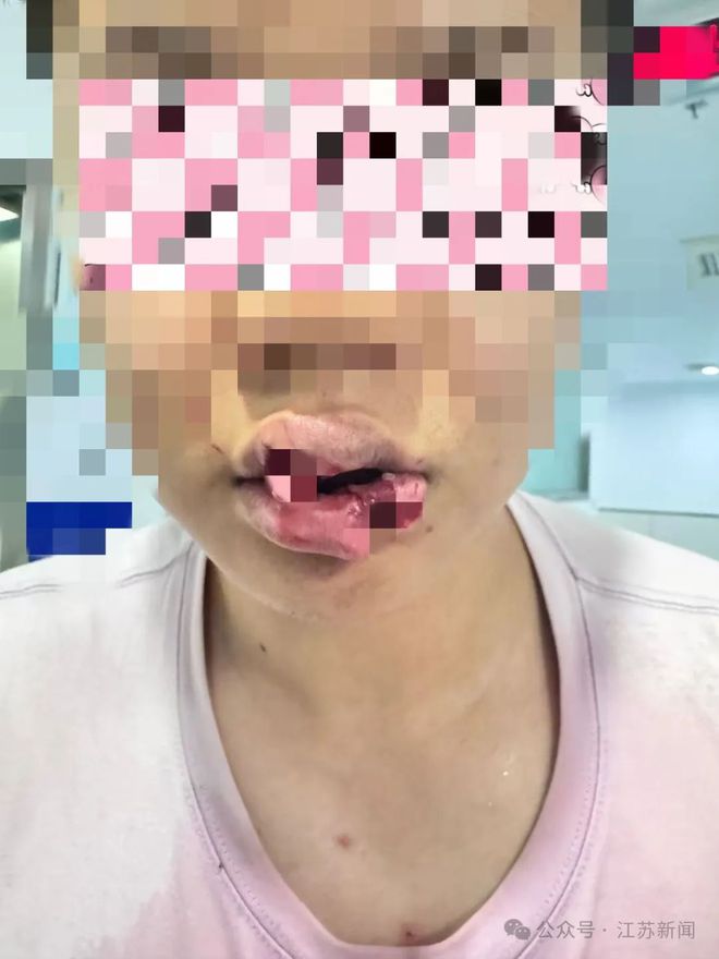 男子與愛寵親密互動(dòng)發(fā)生意外，嘴唇被咬掉引發(fā)教訓(xùn)與反思