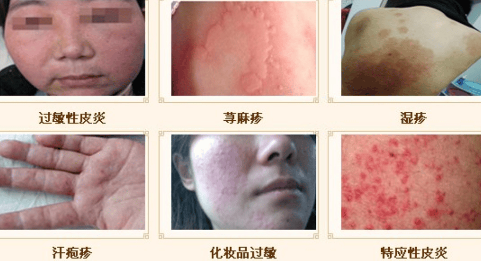 家中如何識別與處理過敏反應(yīng)的方法指南