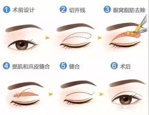 家中眼部創(chuàng)傷的急救處理方法