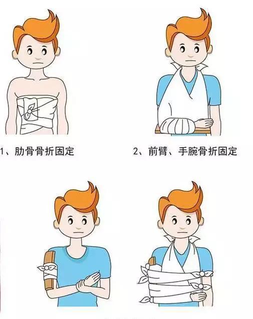 家庭骨折固定指南，全面解析如何正確應(yīng)對(duì)骨折