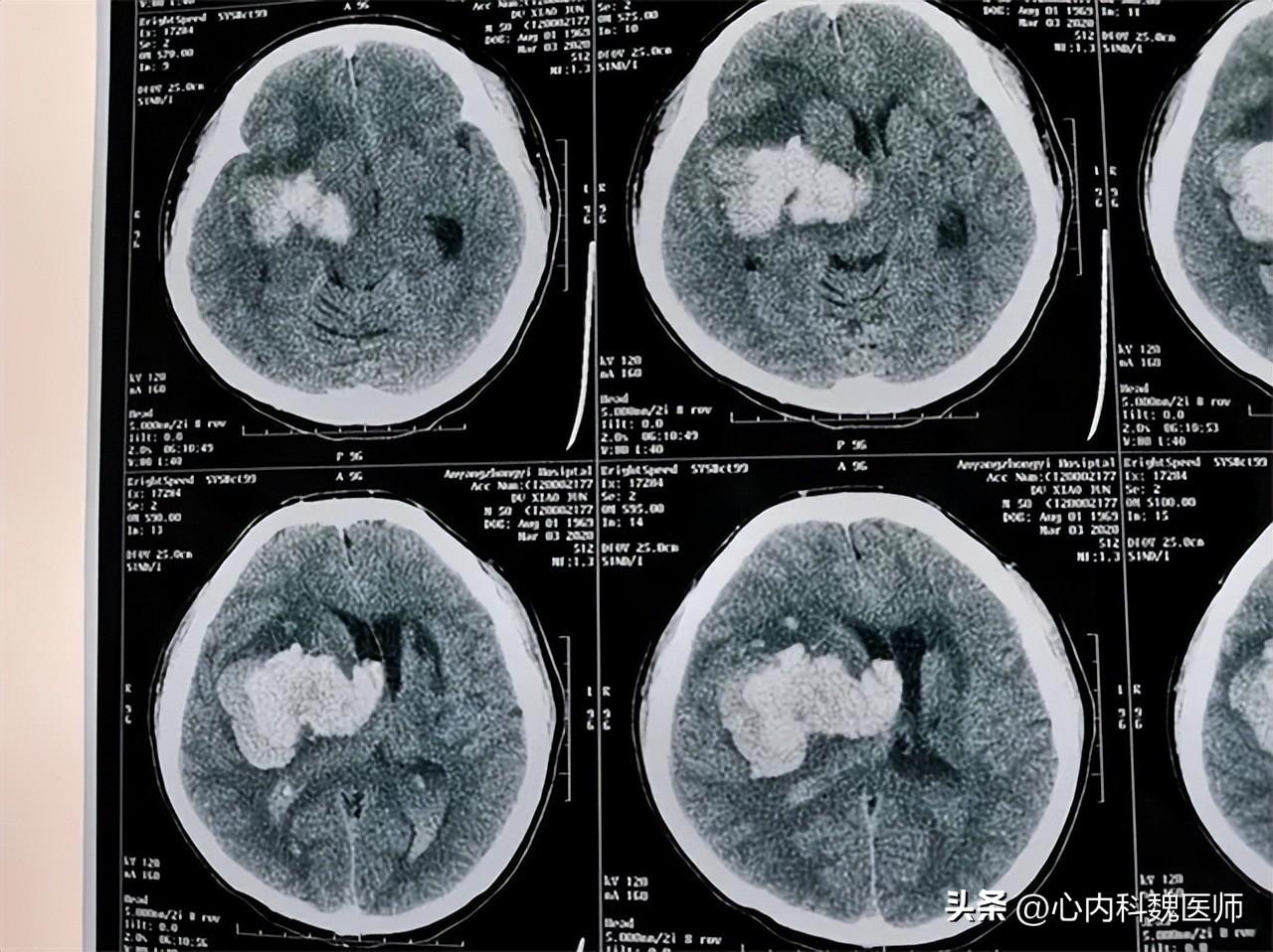 頭部創(chuàng)傷的家庭急救處理與預(yù)防措施