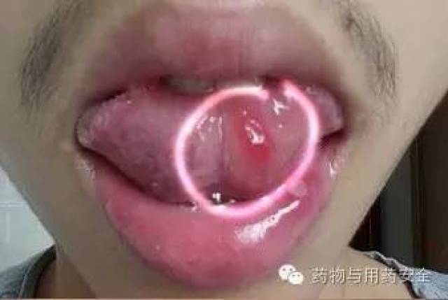 口腔潰瘍疼痛急救指南，應(yīng)對處理全攻略