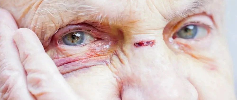 家庭眼部損傷的預防與處理指南