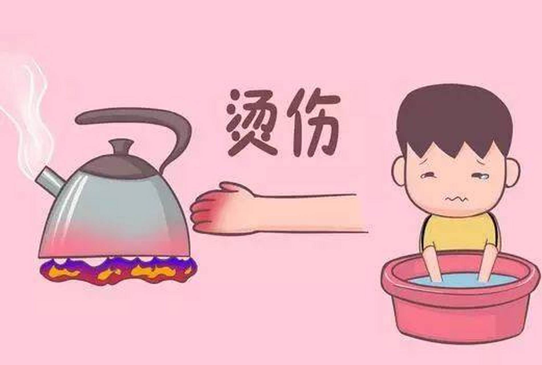 家庭急救指南，小孩燙傷處理步驟