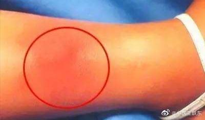 中醫(yī)治療頭痛的常見方法簡述