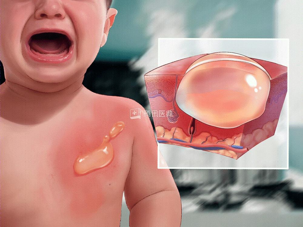 家庭急救指南，應(yīng)對意外燙傷的處理方法